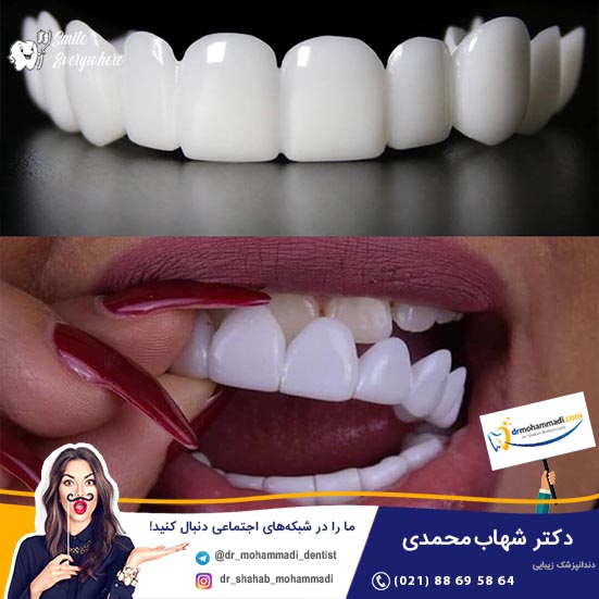 اسنپ ان اسمایل چیست و چه تفاوتی با لمینت دندان دارد؟ - کلینیک دندانپزشکی دکتر شهاب محمدی